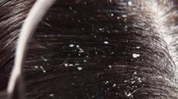 أنواع قشرة الرأس وأسبابها الرئيسية: كيف تؤثر العوامل المحفزة على صحتك الجلدية؟